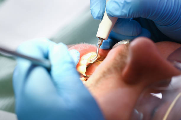 Best Emergency Gum Treatment in Mckenzie, TN